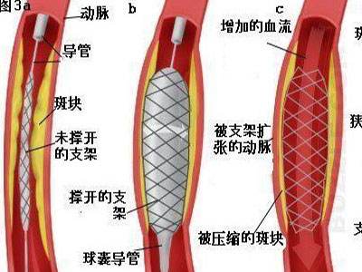 什么是冠心病？(图2)