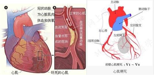 什么是心肌缺血(图1)