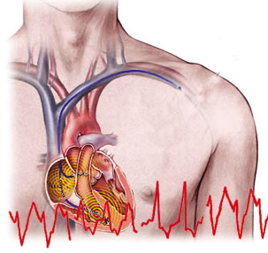 充血性心力衰竭(图1)
